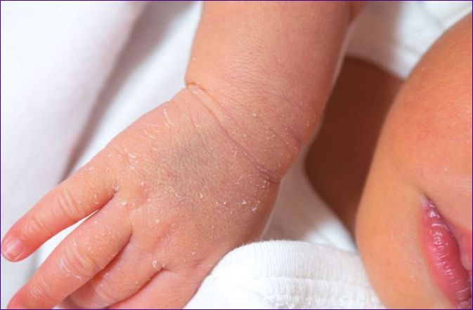 Droge huid op baby's lichaam, handen en voeten: oorzaken, overzicht van 10 huidverzorgingsproducten