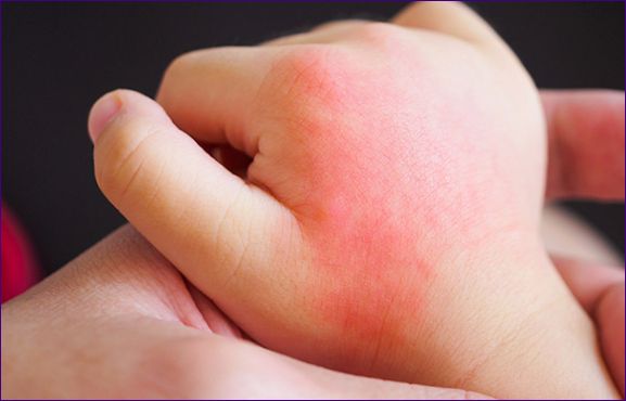 Droge huid op baby's lichaam, handen en voeten: waarom, overzicht van 10 huidverzorgingsproducten
